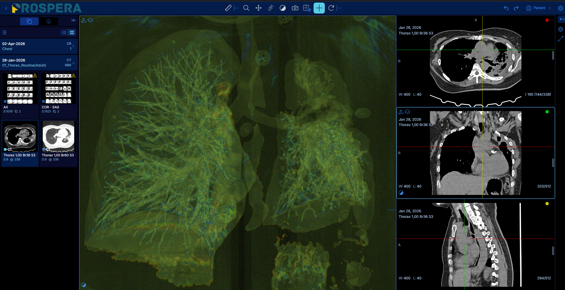 Prospera DICOM Viewer â pulmonary CT 3D rendering